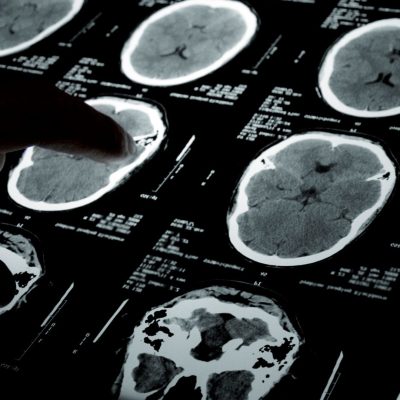 The tumor microenvironment and integrated cellular medicine: the new frontier in precision oncology